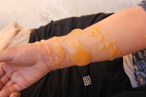 Hautreizungen und Verätzungen